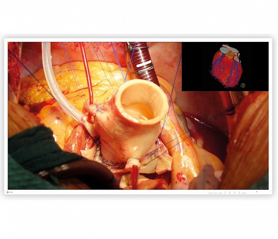 EIZO CuratOR EX4342 43" 4K UHD Surgical Monitor with HDR, BT.2020 Wide Color Gamut, and IP45 Front Protection